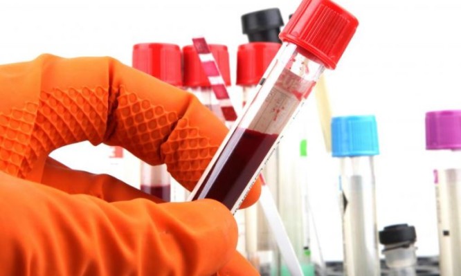 Αιματοκρίτης: Τι σημαίνουν τα όρια στην εξέταση αίματος – Ποιες παθήσεις υποδεικνύουν